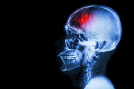 Physiotherapy for Stroke Treatment