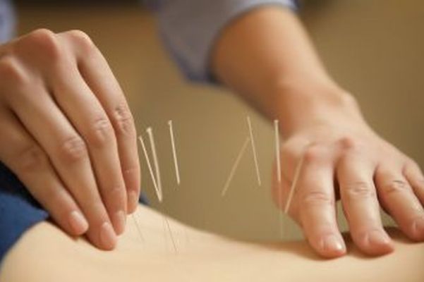 Acupuncture Therapy is usually painless