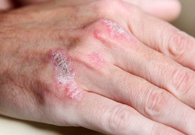 Psoriasis treatment without prescriptions
