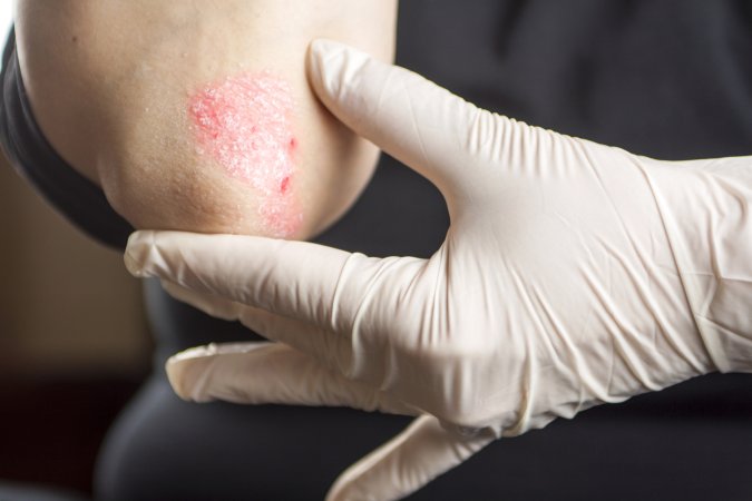 Reducing Psoriasis Flare-ups